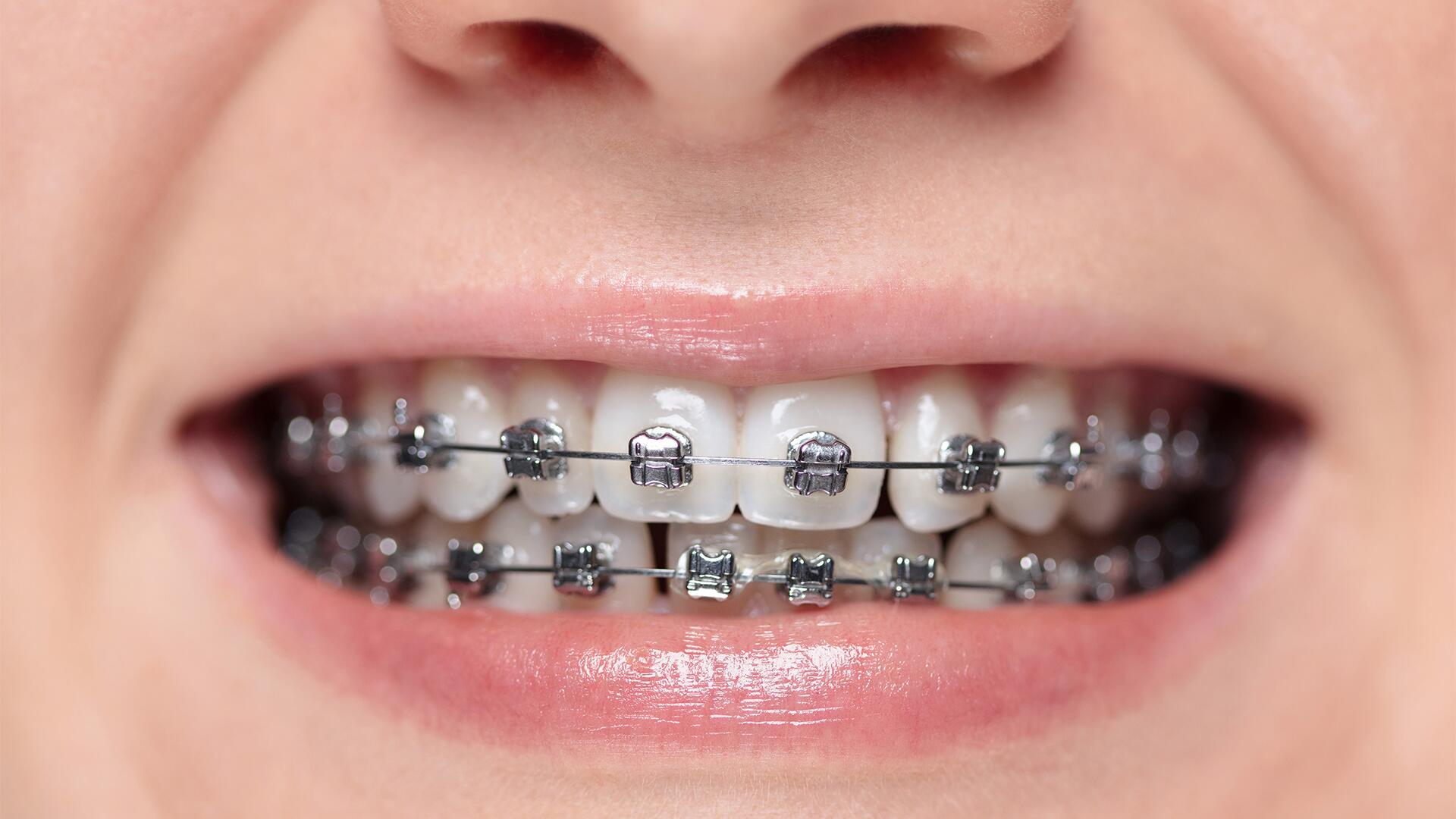 Zahnspangenmaterialien im Test: Viele überzeugen Zahnspangenmaterialien im Test: Viele überzeugen