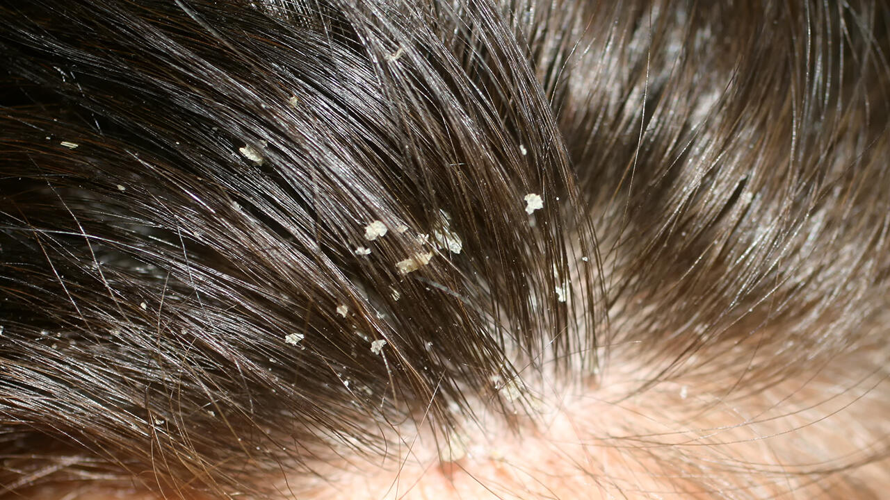sanft ÖKO-TEST Test: alle - Anti-Schuppen-Shampoos Kopfhaut im schuppender zu Nicht