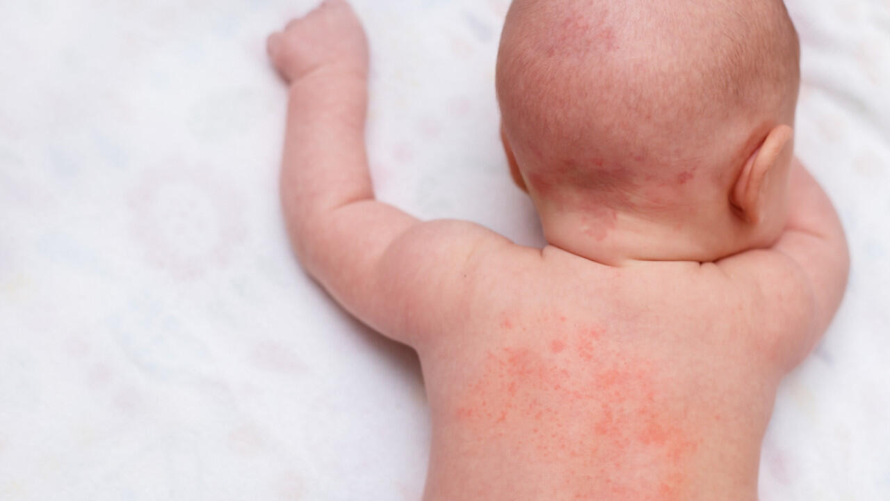 Babys sind anfällig für Hitzepickel, da ihre Schweißdrüsengänge noch nicht vollständig ausgebildet sind.