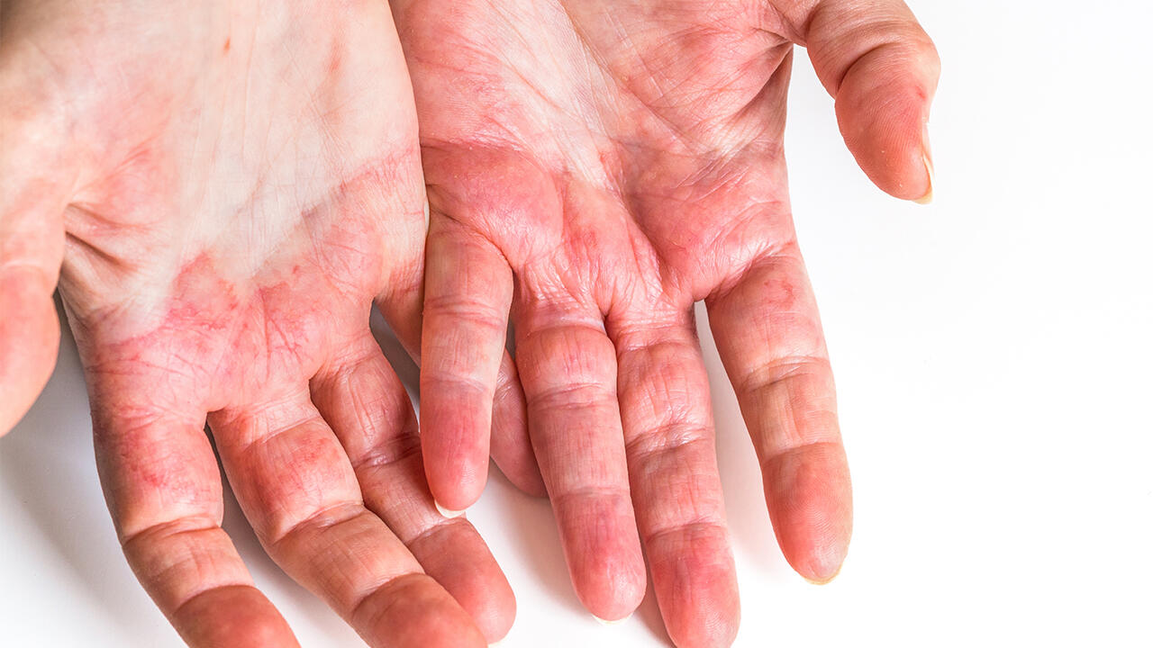 Bei Hauterkrankungen wie Neurodermitis können pH-hautneutrale Waschlotionen eine gute Basispflege sein. Bei Hauterkrankungen wie Neurodermitis können pH-hautneutrale Waschlotionen eine gute Basispflege sein.