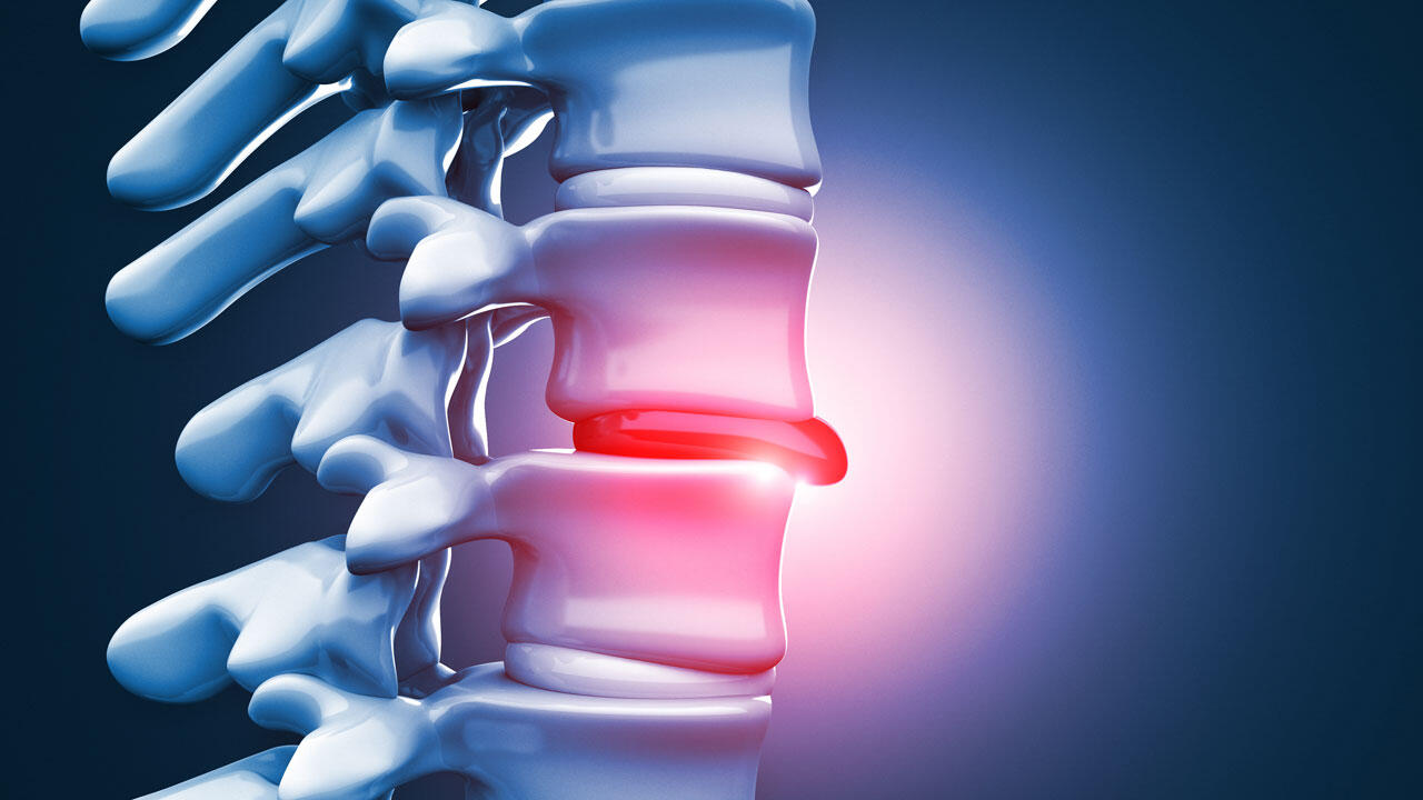 Rückenschmerzen, die ins Bein oder in den Arm ausstrahlen, können auf einen Bandscheibenvorfall hinweisen.