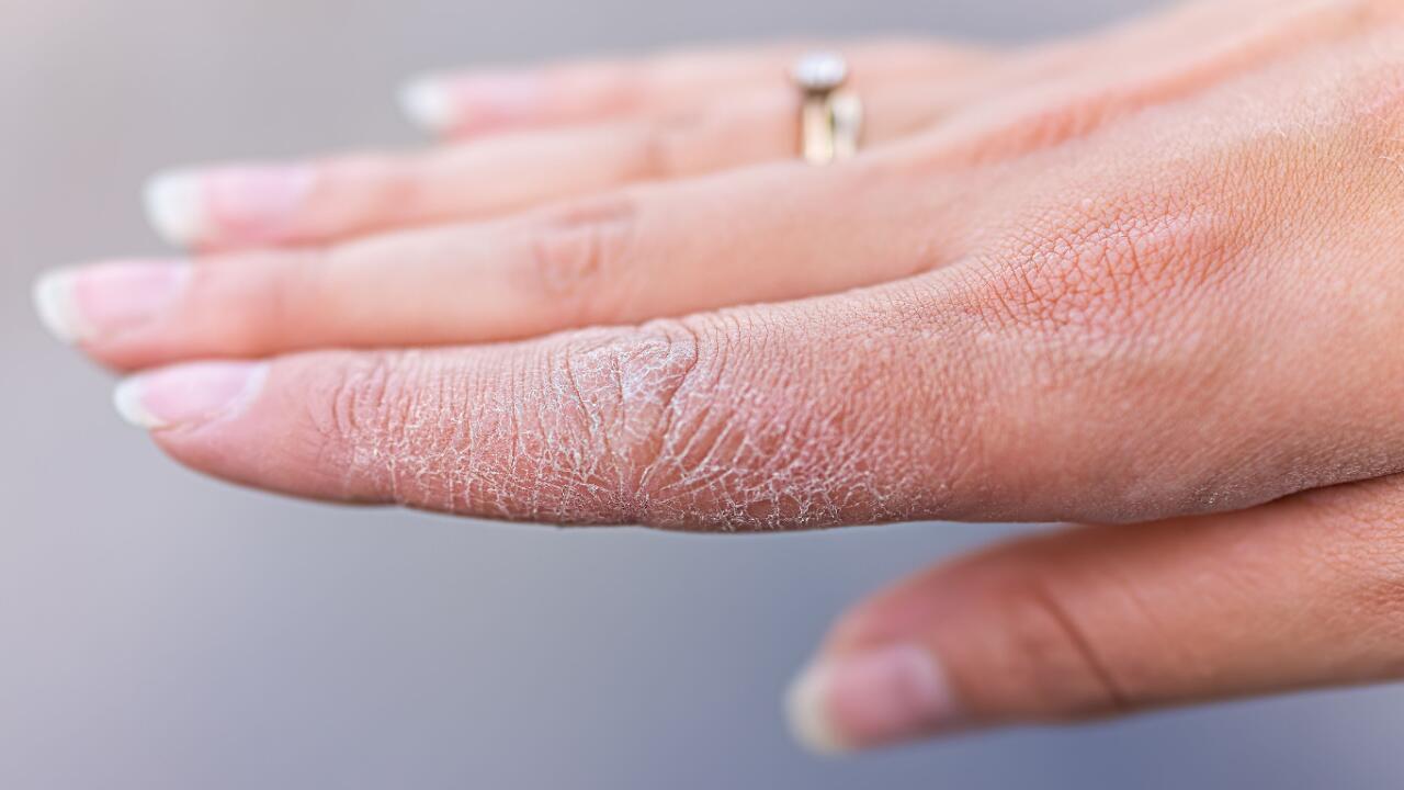 Trockene Hände im Winter: Tipps gegen spröde und rissige Haut